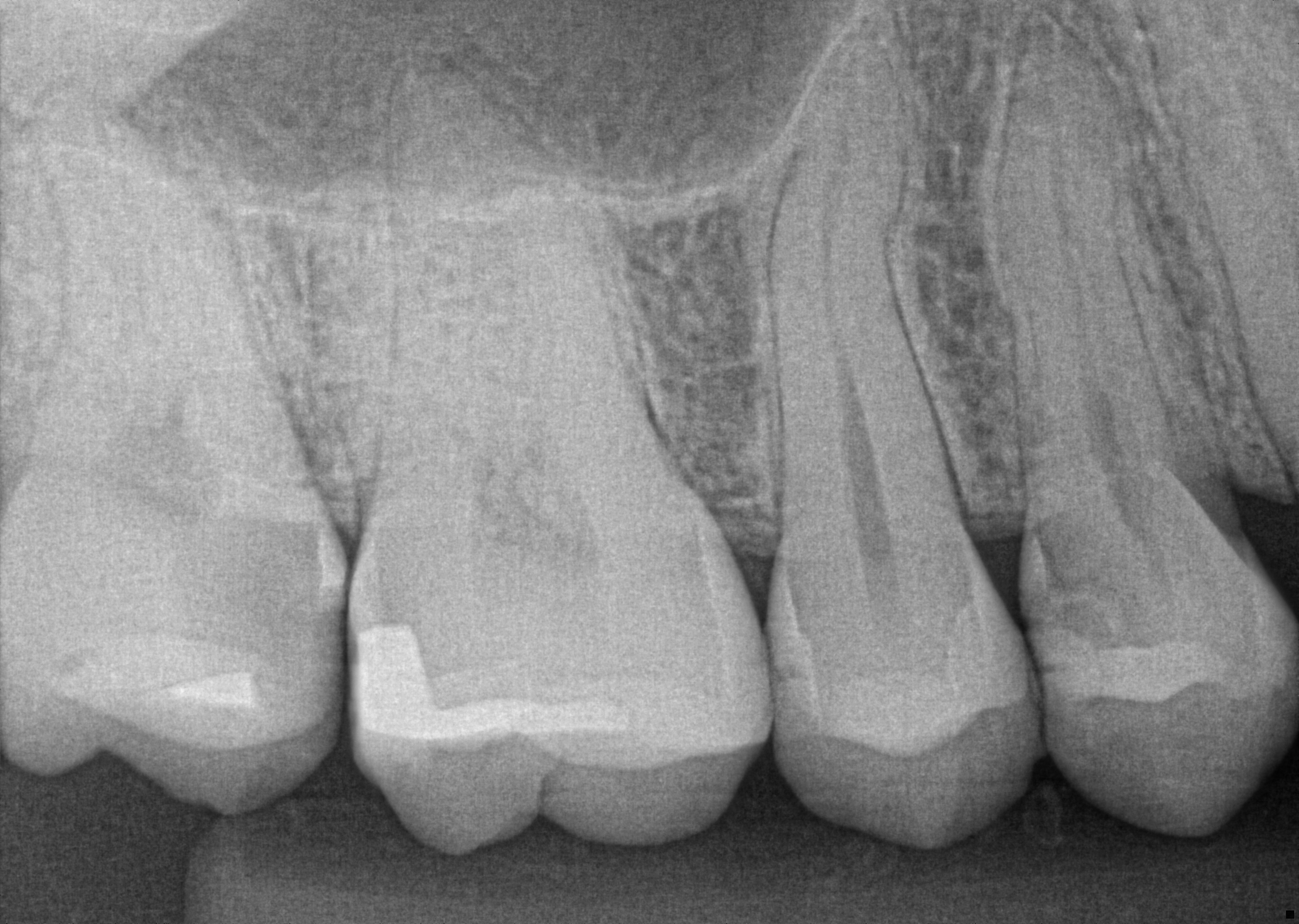 Pre-Operative Radiograph