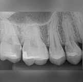 Molar RCT - Pre-Operative