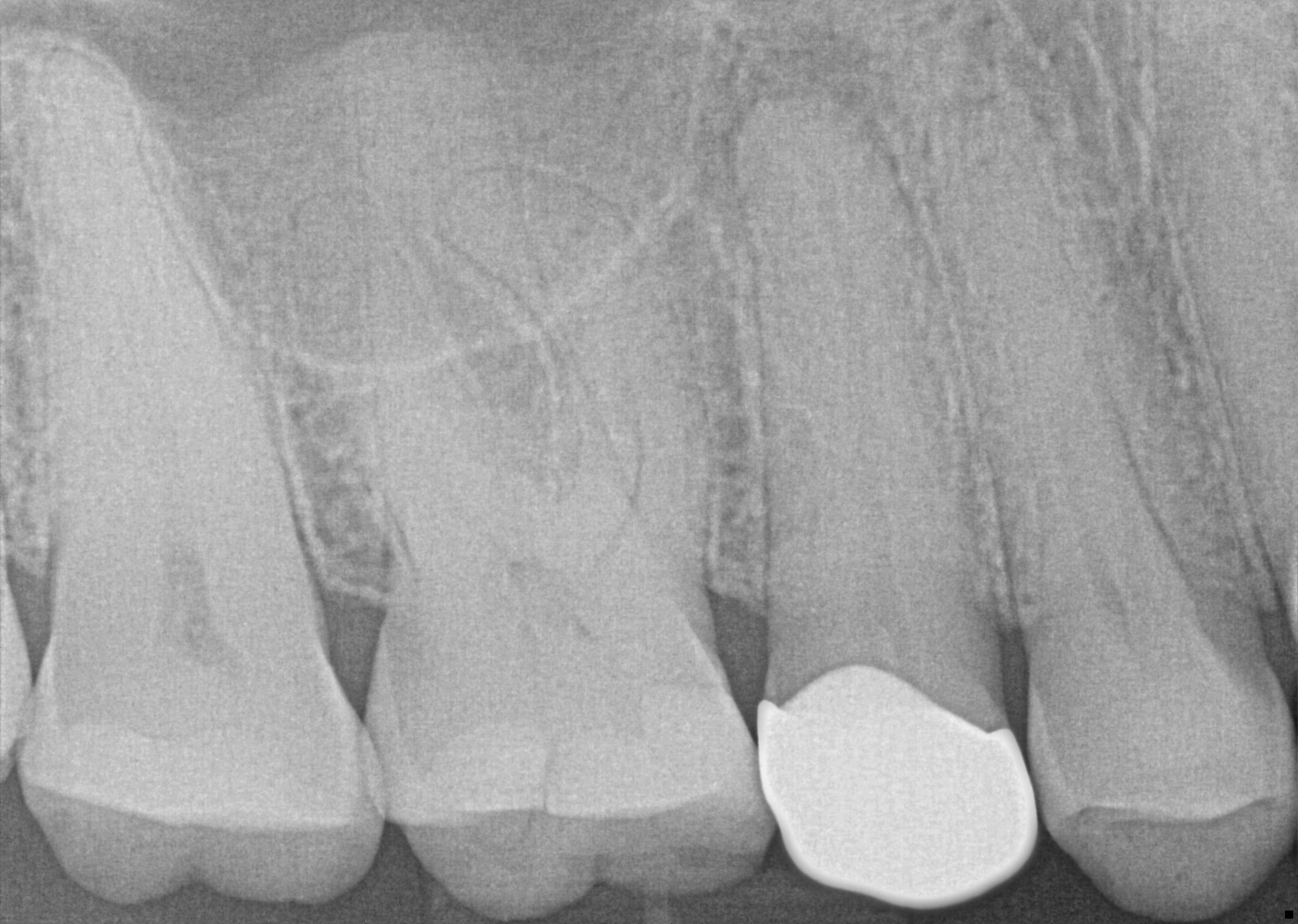 Pre-Operative Radiograph