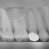 Premolar RCT - Pre-Operative