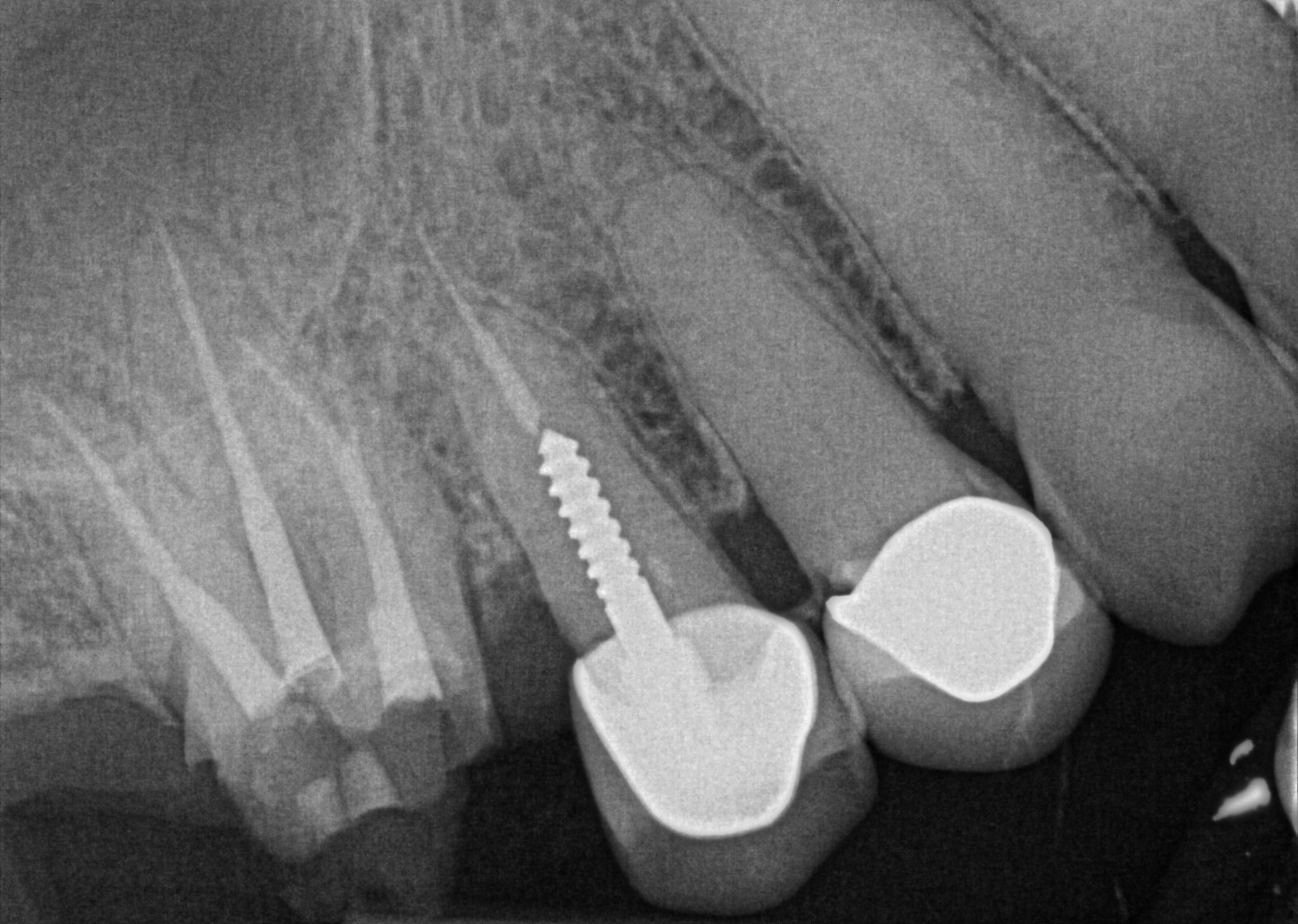 Post-Operative Radiograph