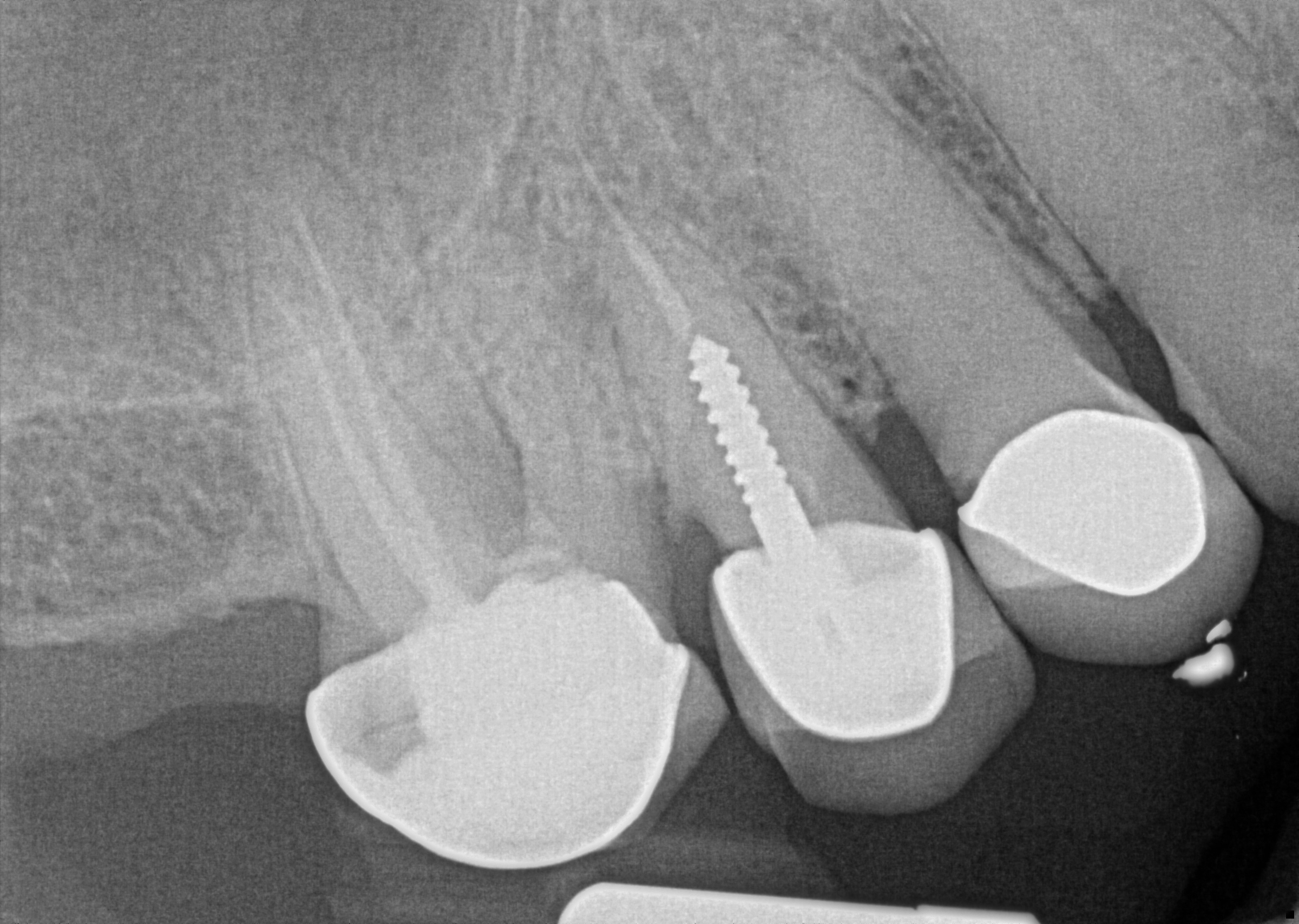 Pre-Operative Radiograph