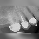 Molar Retreatment - Pre-Operative