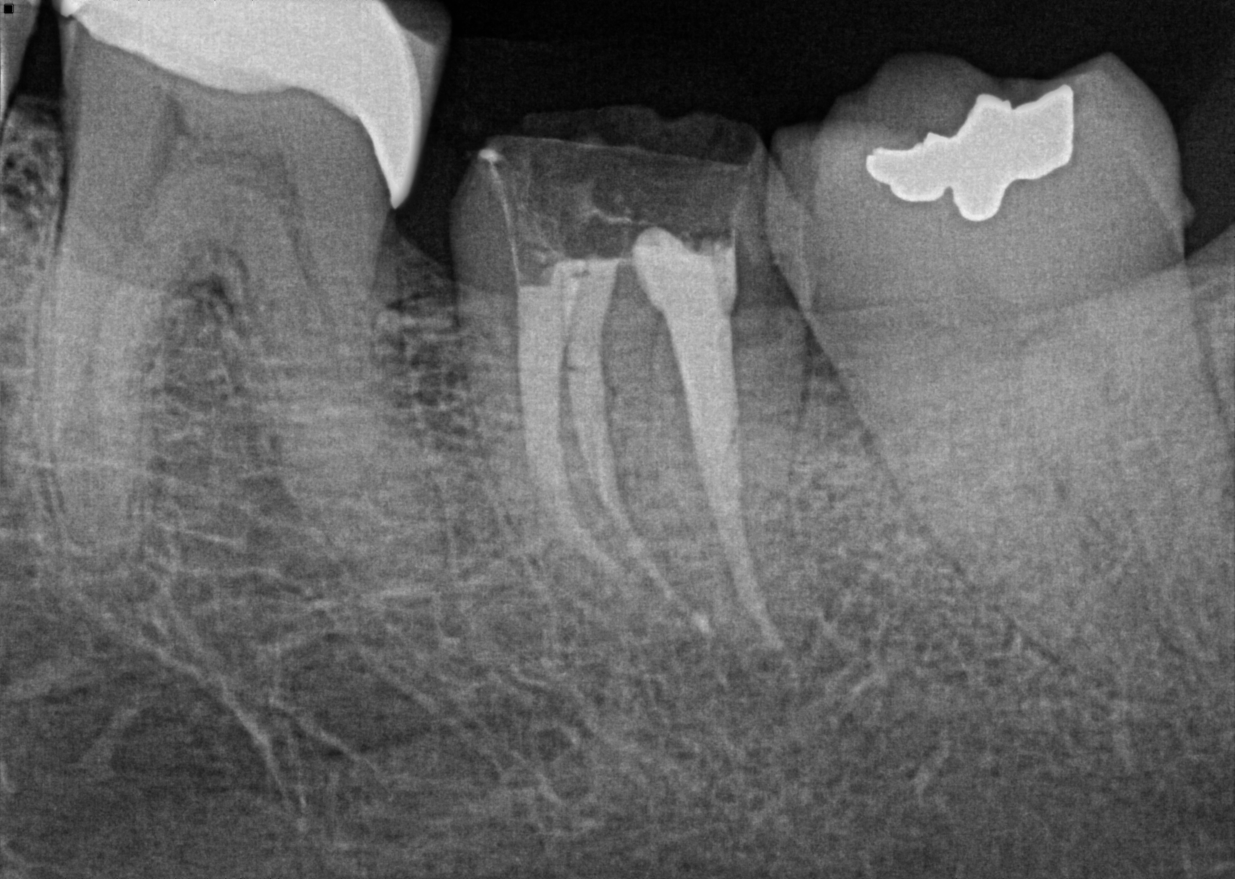 Post-Operative  Radiograph