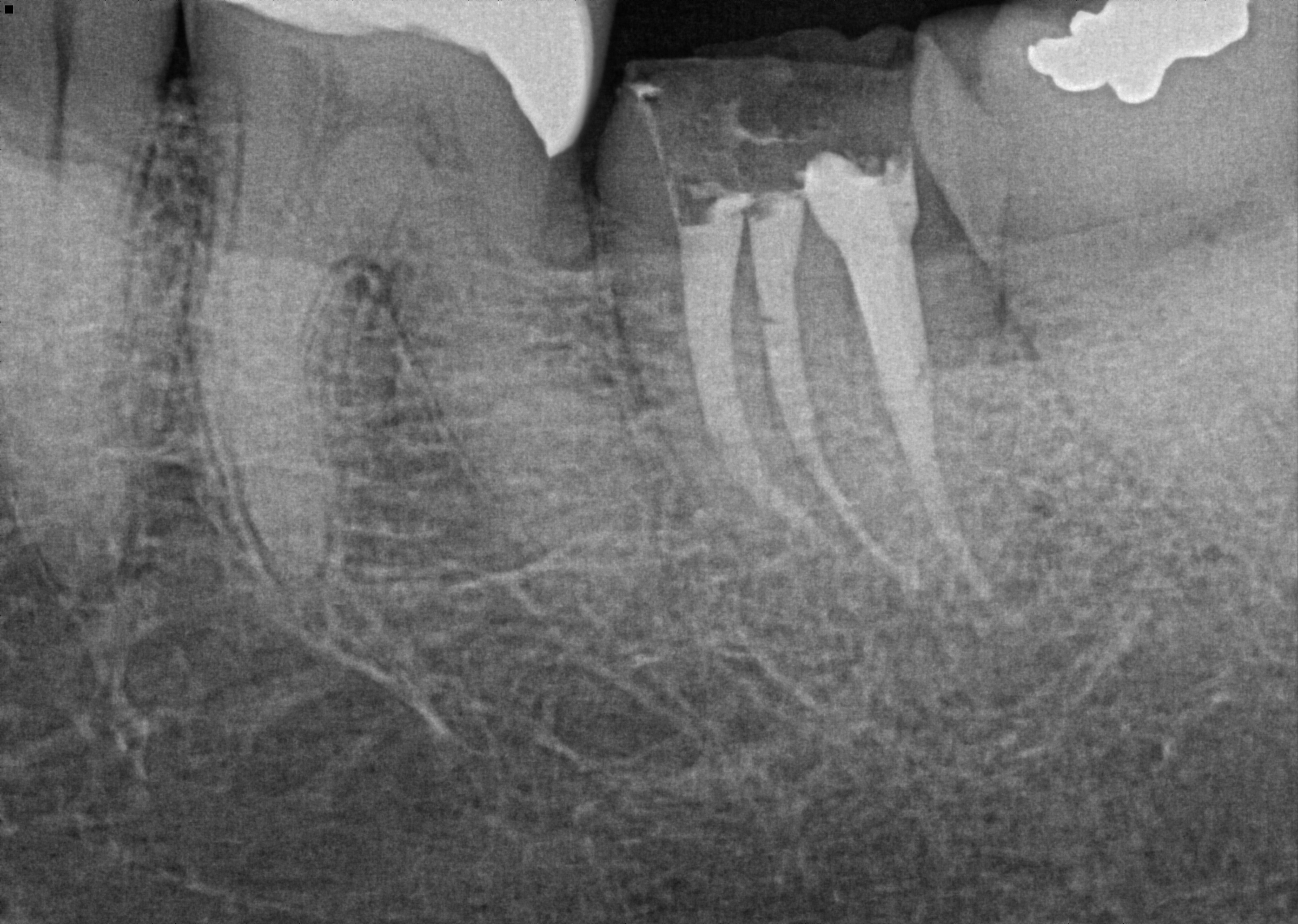 Post-Operative shift Radiograph