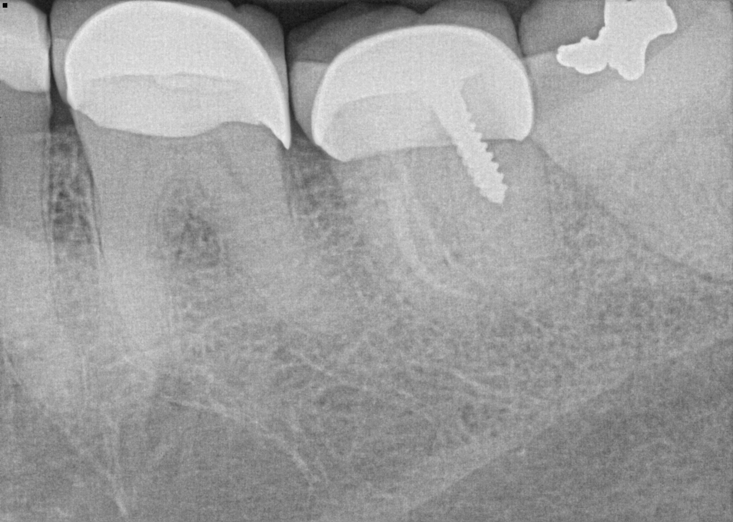 Pre-Operative Radiograph