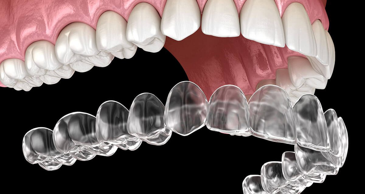 Orthodontic Clear Aligners