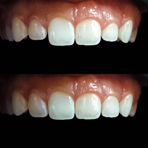 Anterior Composite Veneers