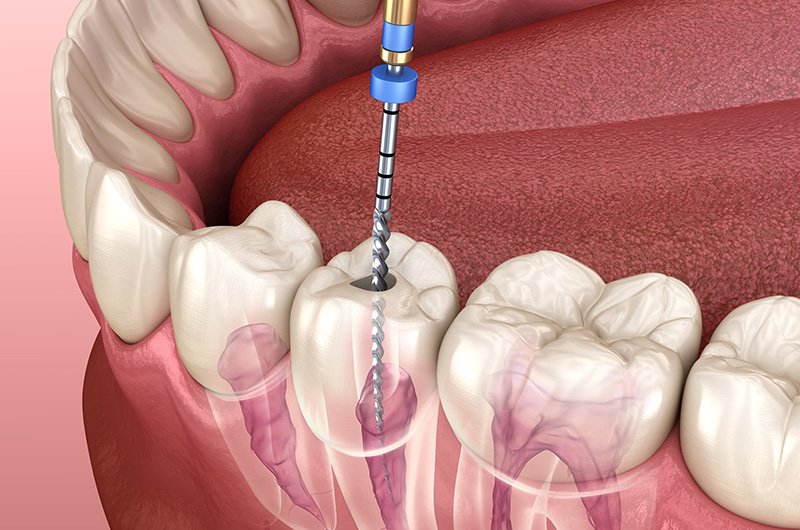 Endodontic Therapy