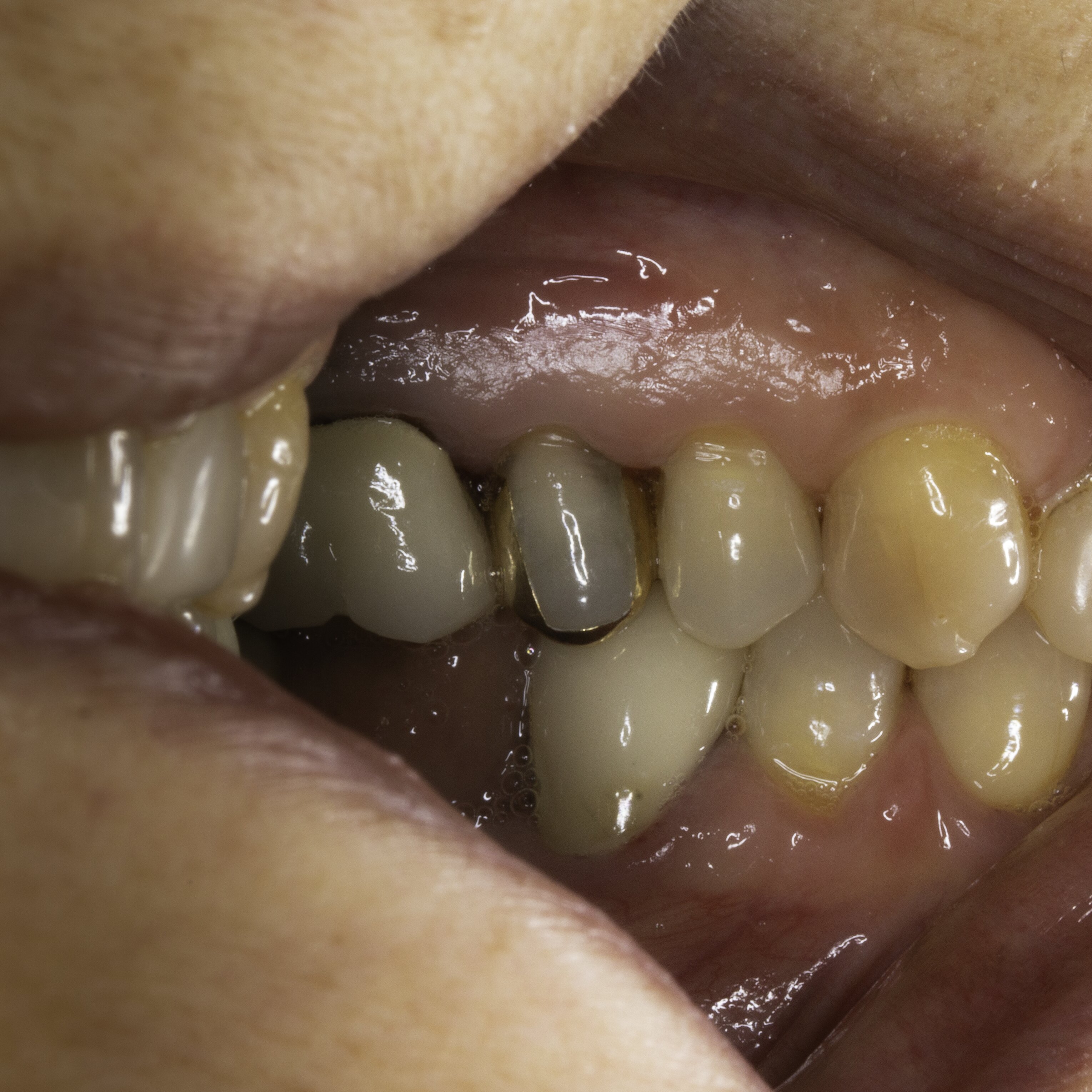 IntraOral bite