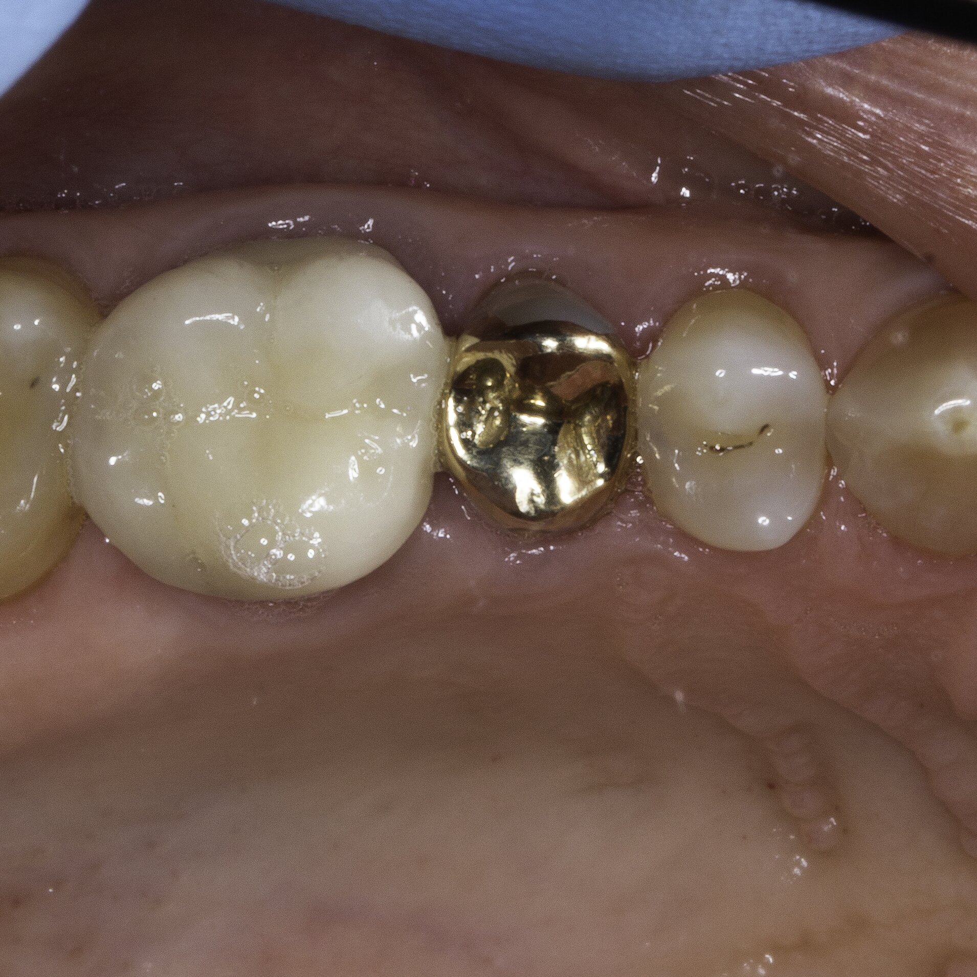 IntraOral Occlusal