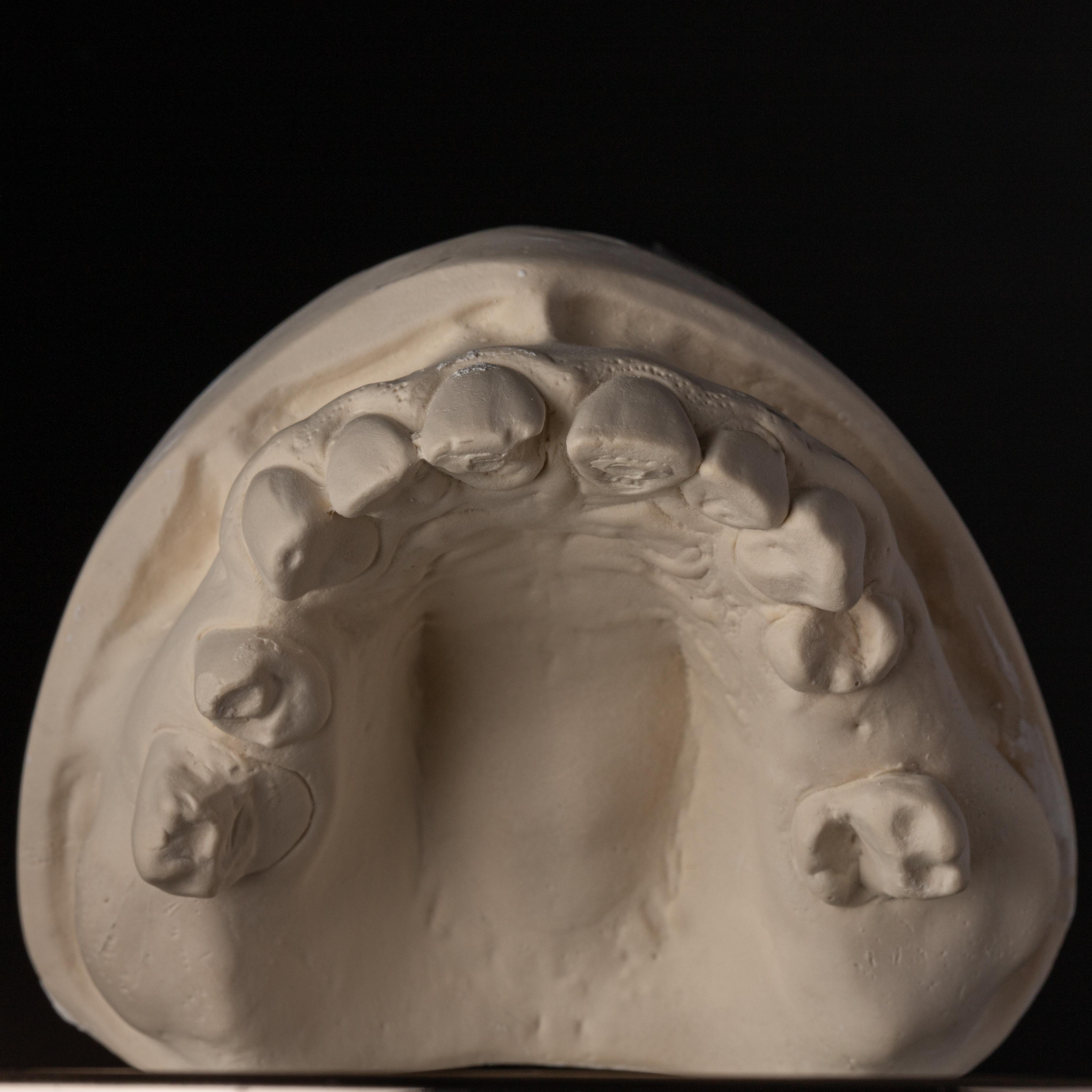 Cast Occlusal View