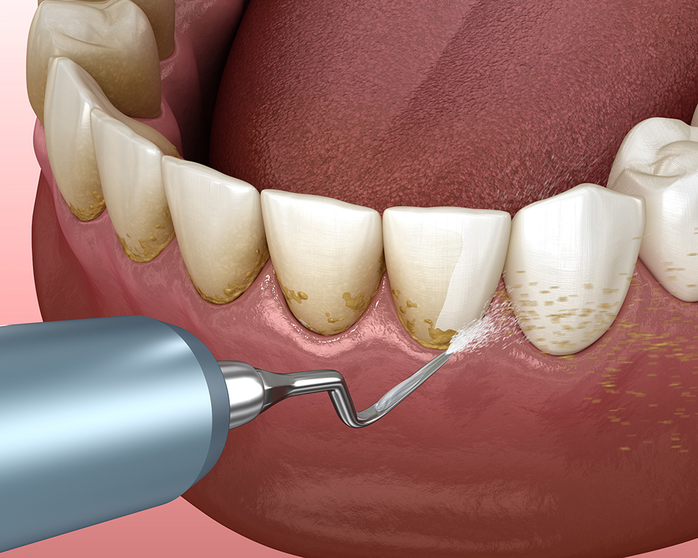 Periodontal Therapy