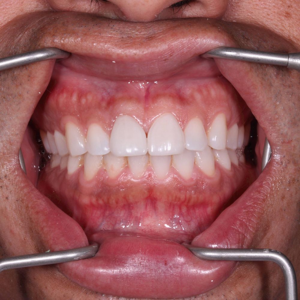 Porcelain veneers