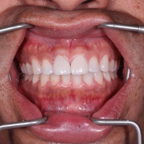 Porcelain Veneers