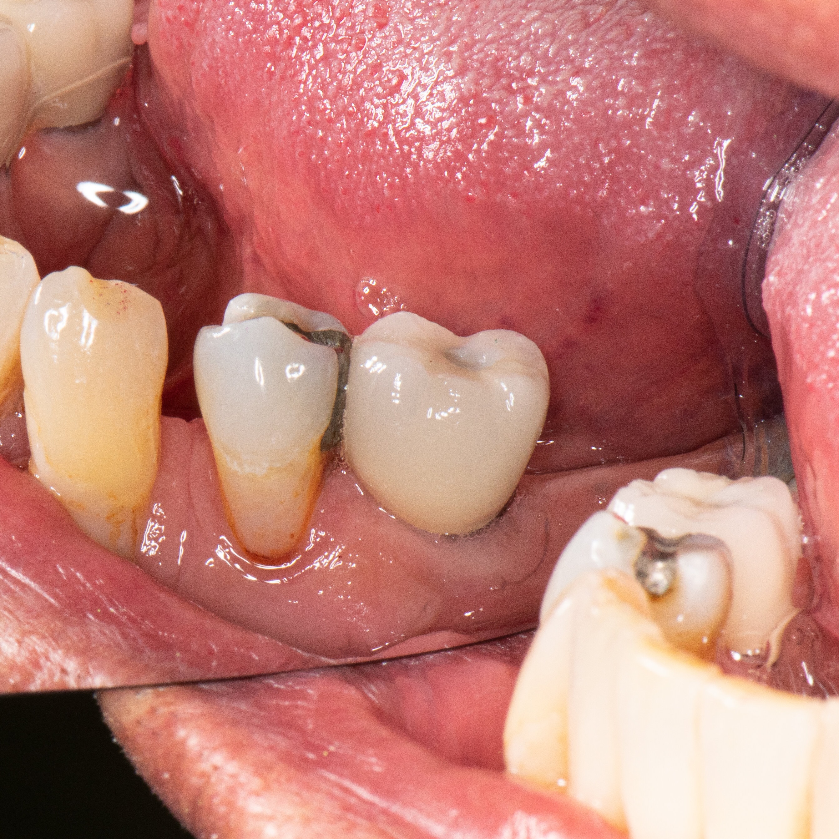 Intra Oral Buccal Rt View