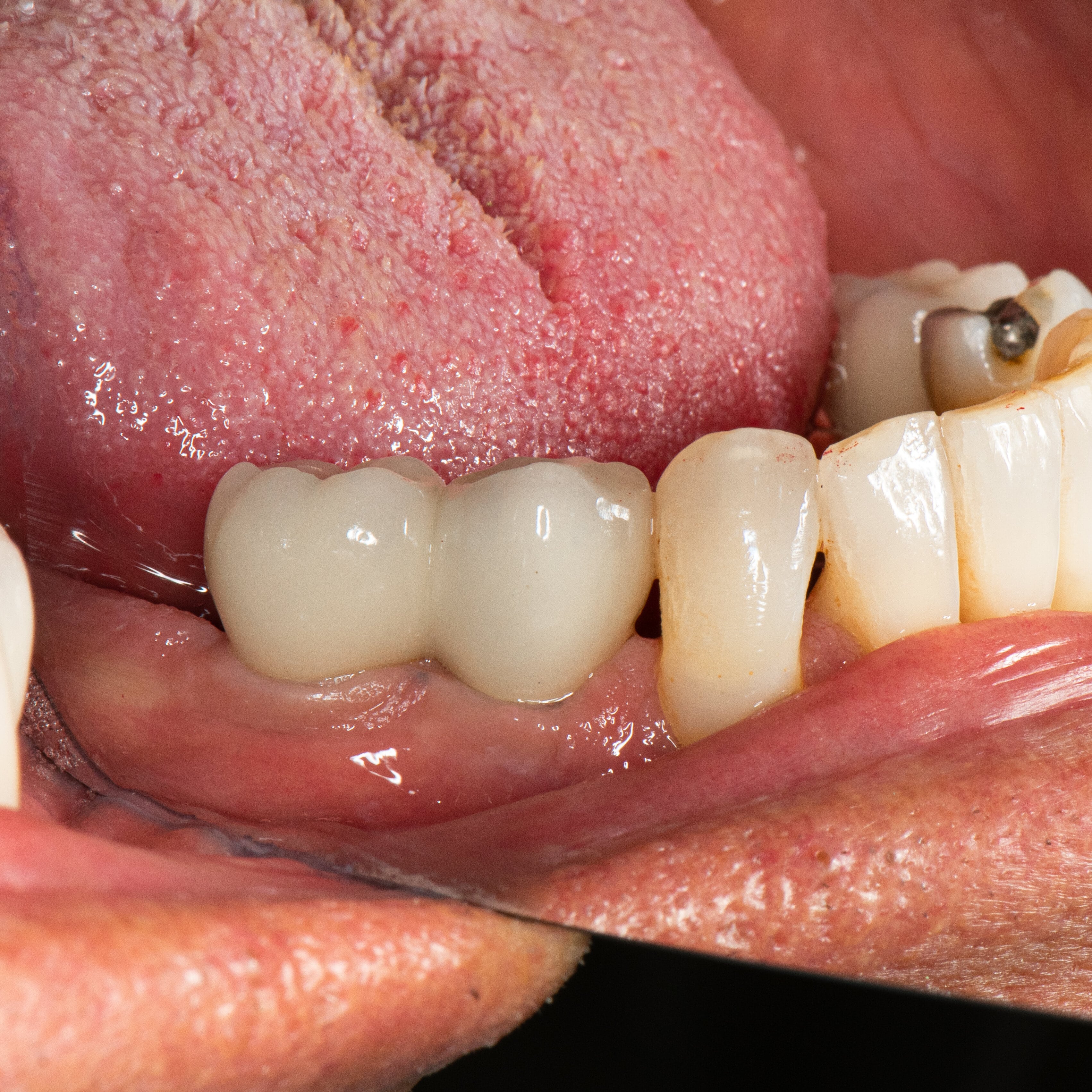 Intra Oral Buccal Lt View