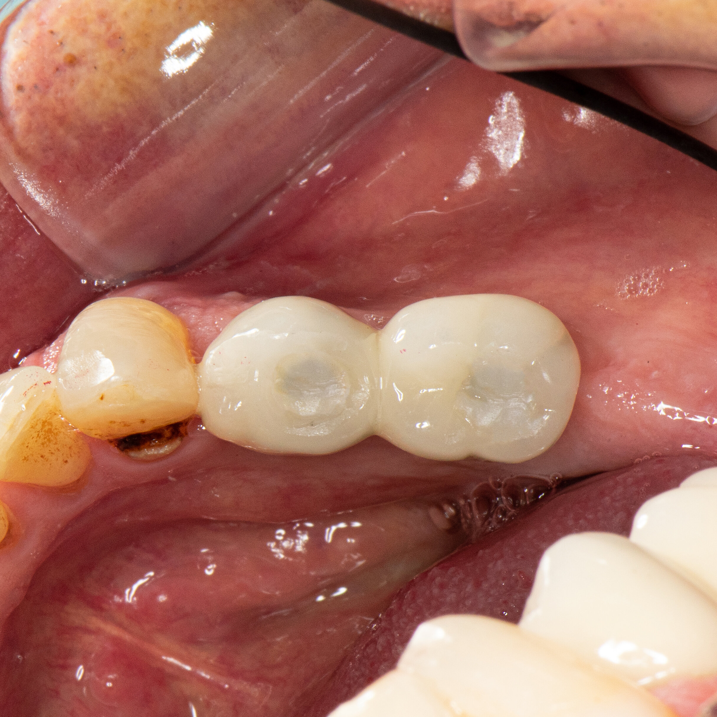 Intra Oral Occlusal Lt View