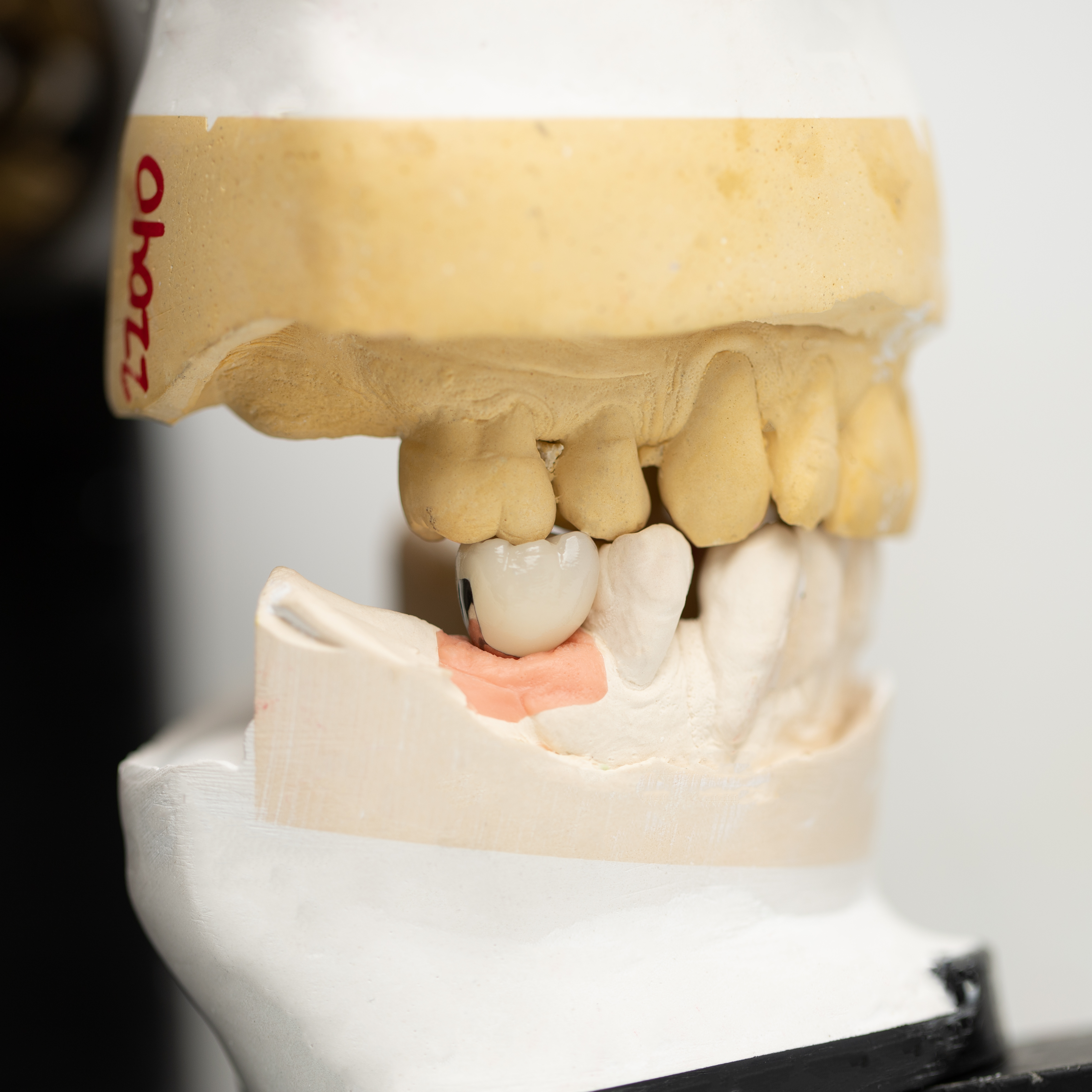 Complete Denture