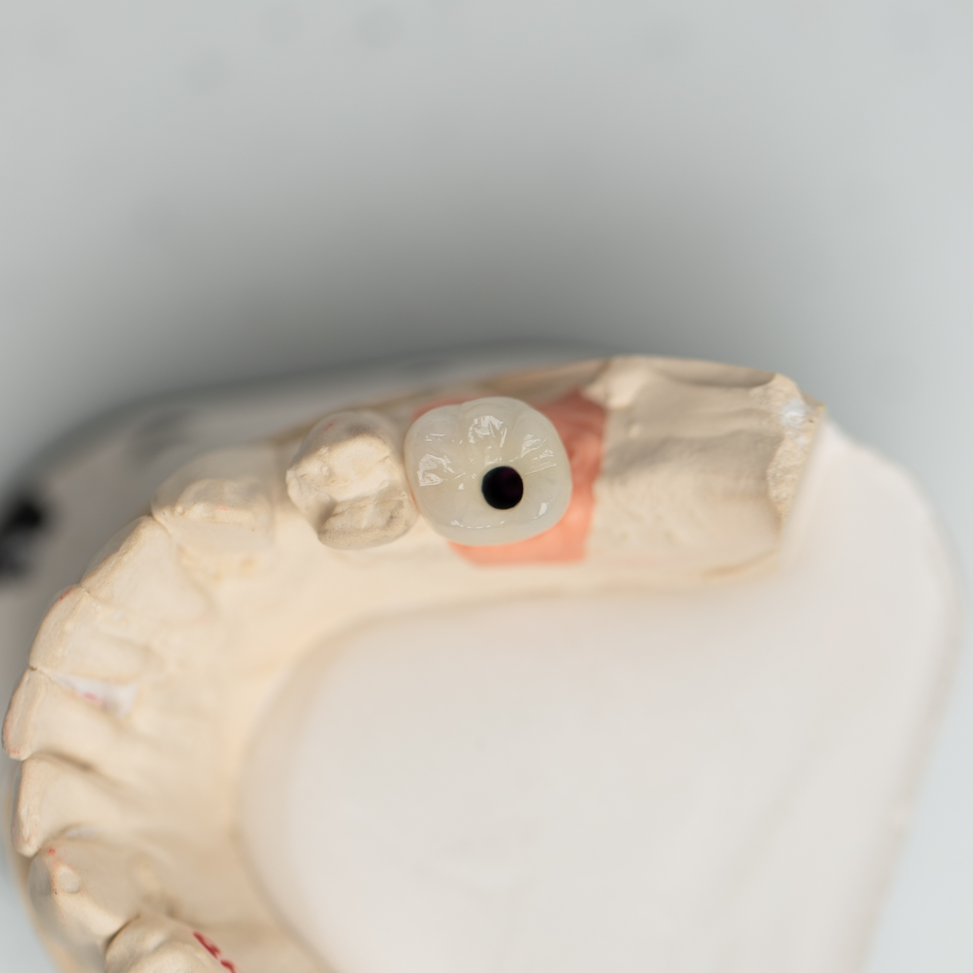 Cast Occlusal View