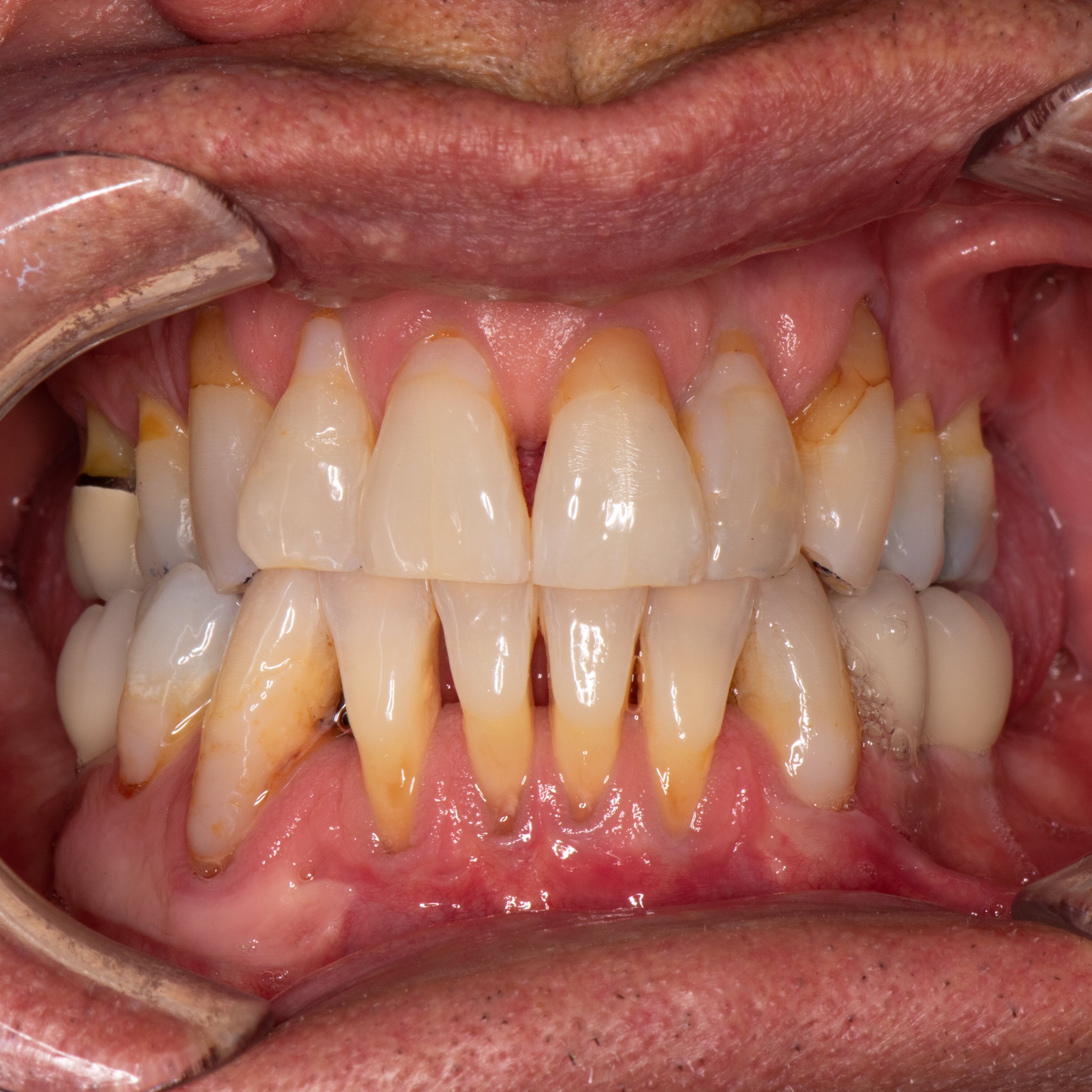 IntraOral Frontal View