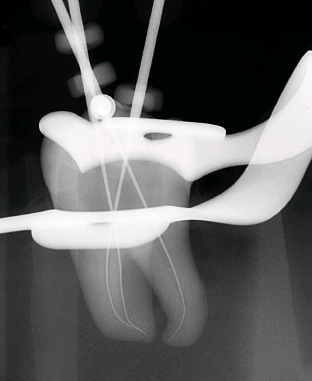 Initial Apical File