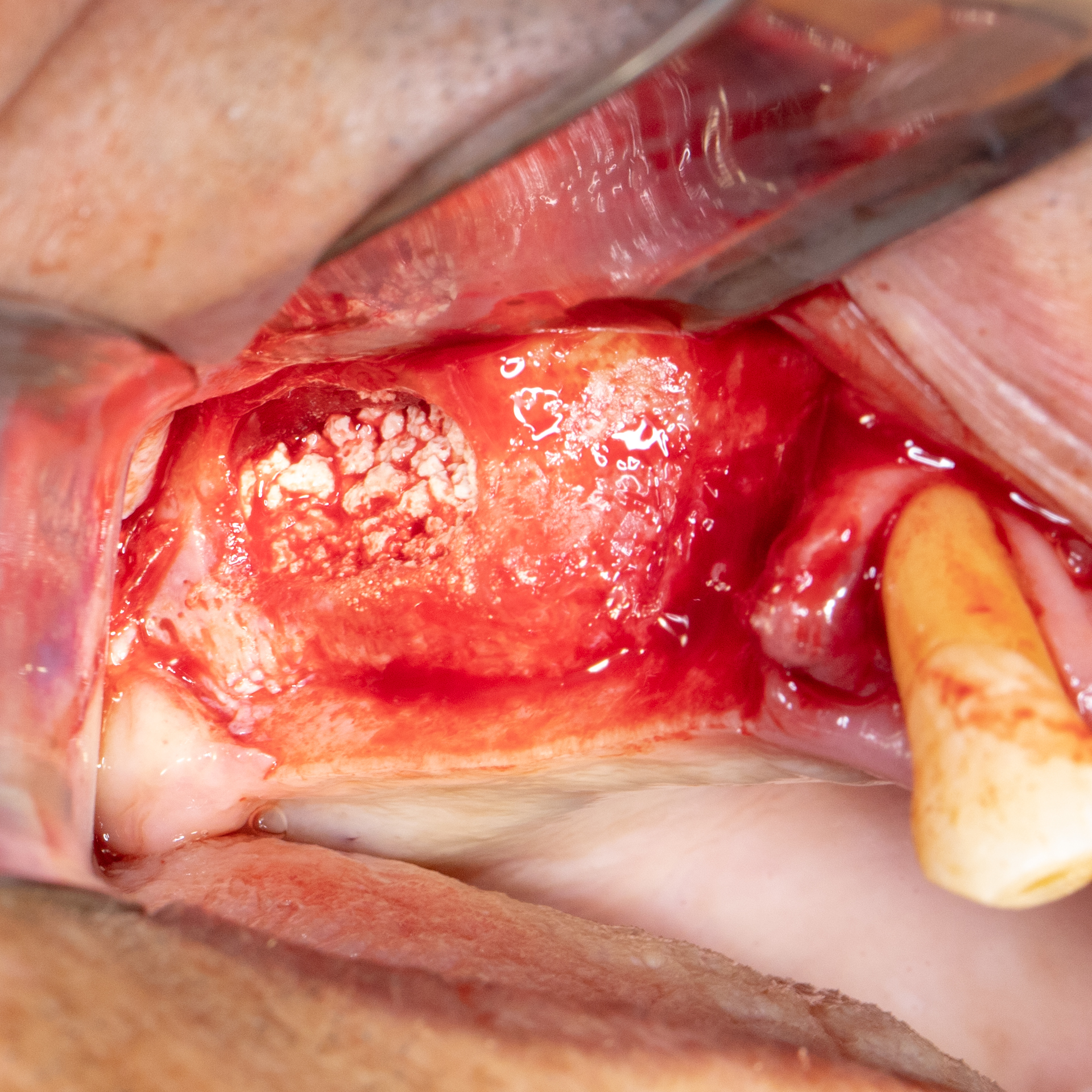 Sinus lift bone Graft