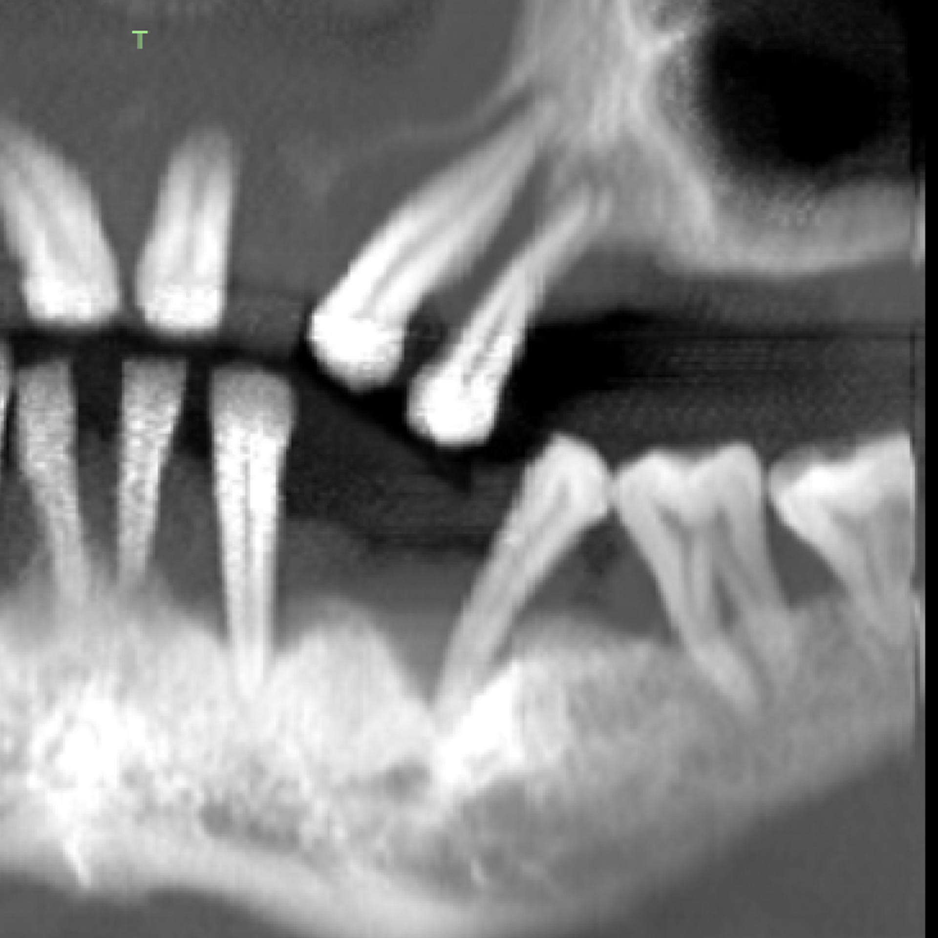 Pre-Operative CBCT