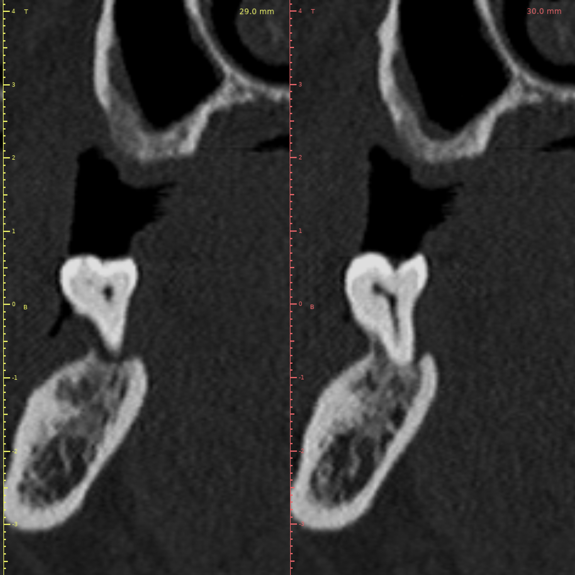 Pre-Operative CBCT