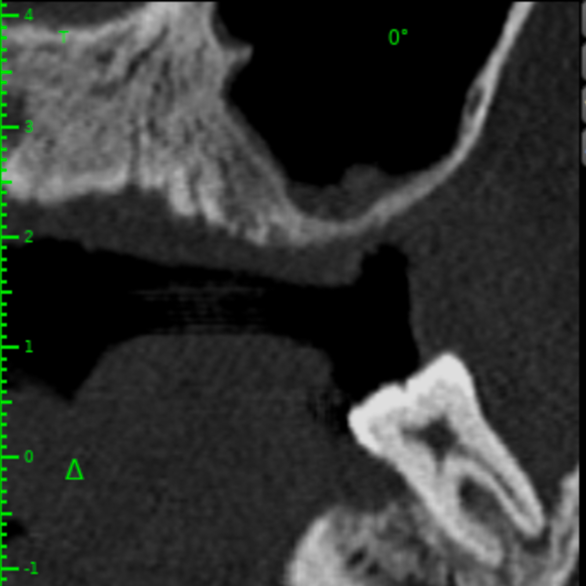 Pre-Operative CBCT