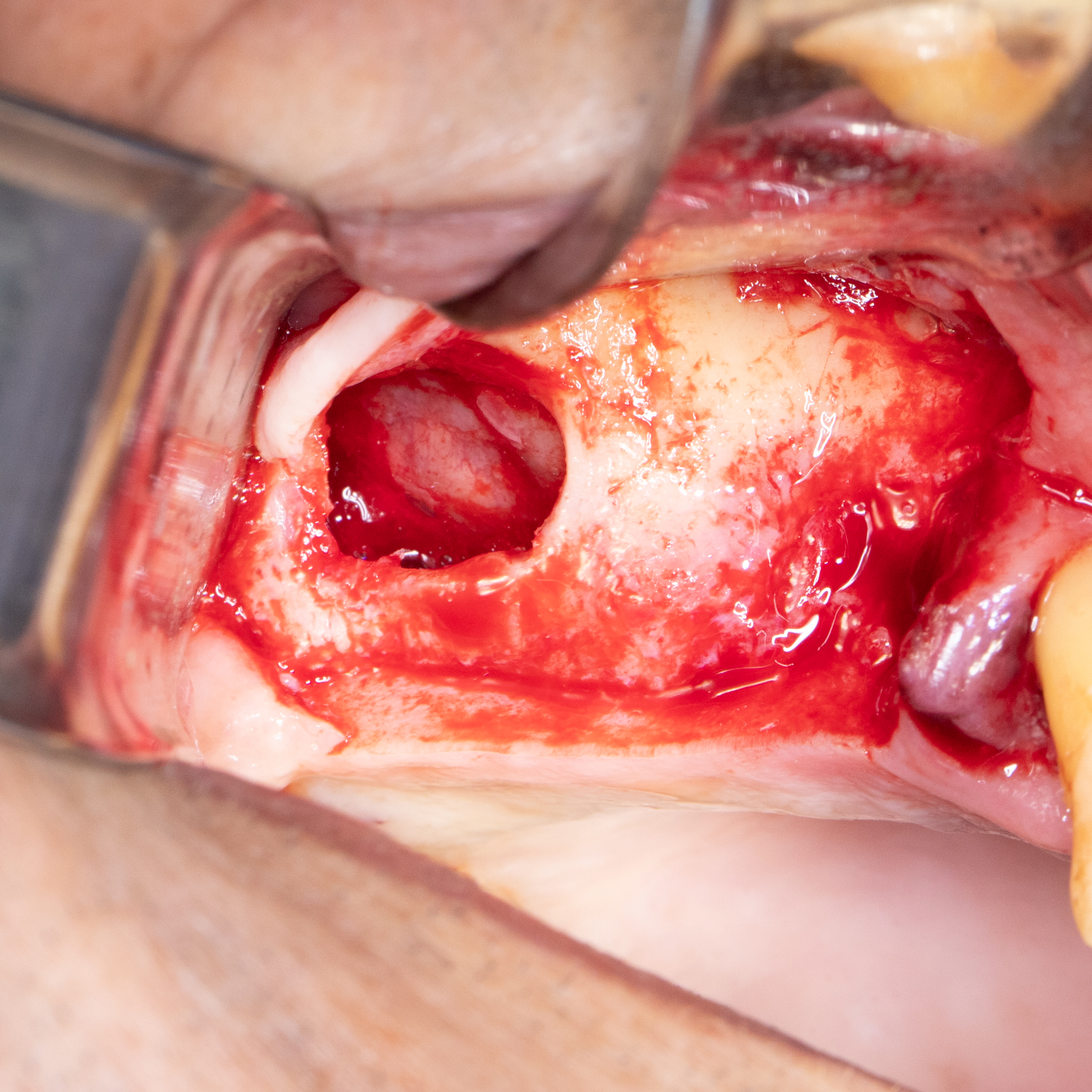 Membrane Exposure