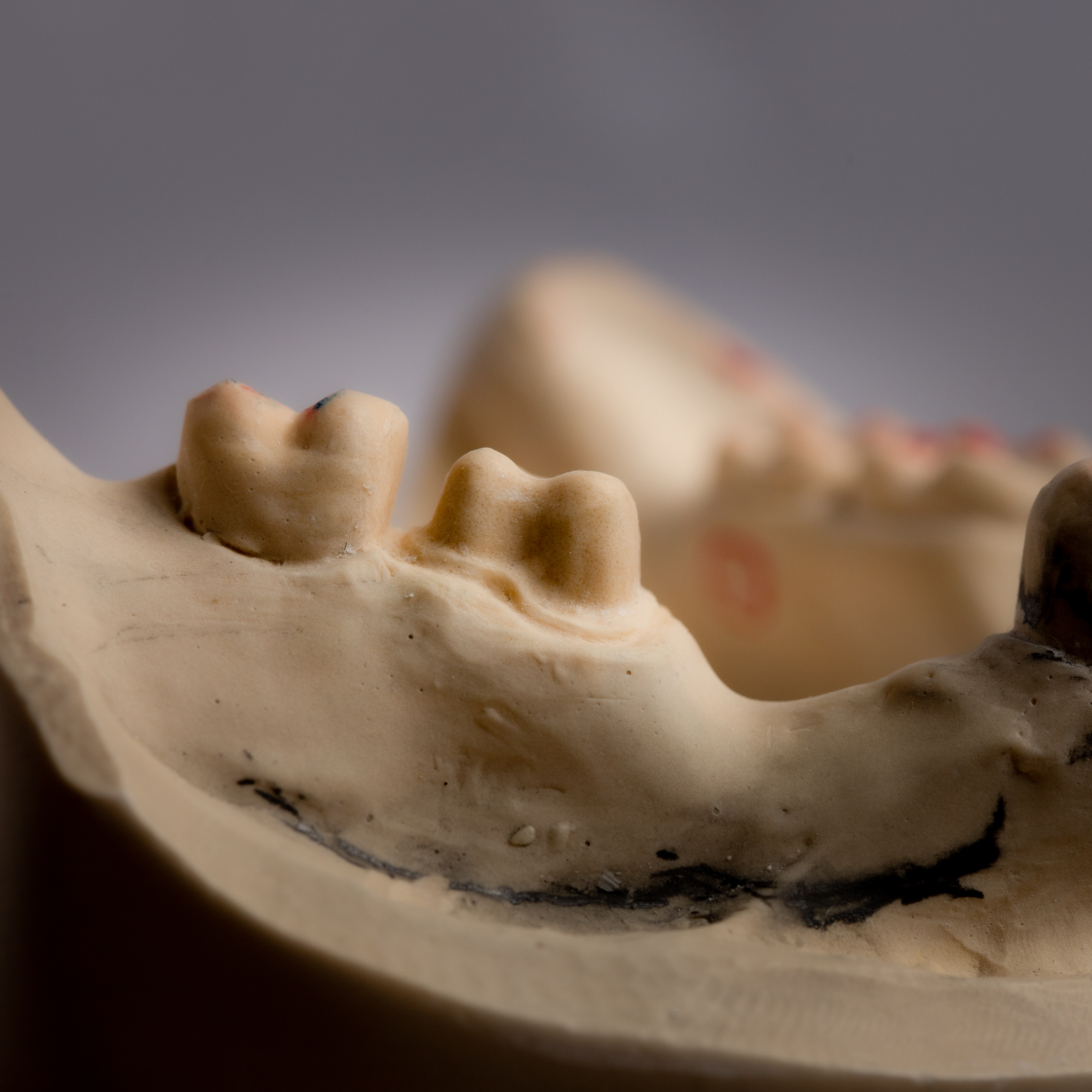 Prep buccal View